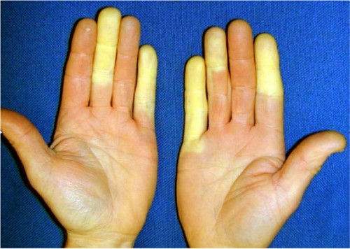 Vibration white finger